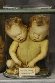 France, Hérault (34), Montpellier, centre historique, faculté de médecine, le musée d'anatomie, foetus de la collection de tératologie qui est l'étude scientifique des malformations congénitales